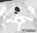 paratracheal air cyst